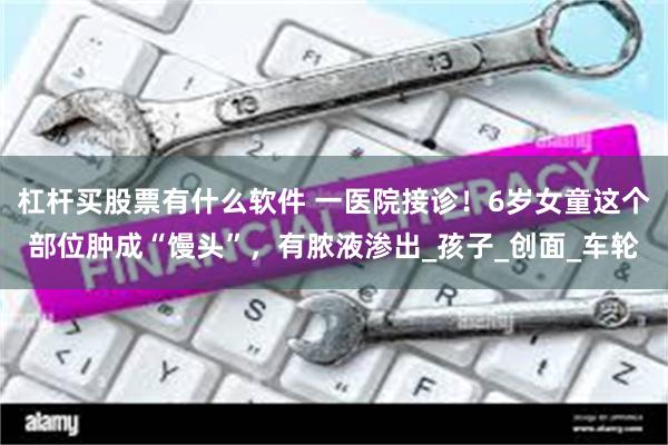 杠杆买股票有什么软件 一医院接诊！6岁女童这个部位肿成“馒头”，有脓液渗出_孩子_创面_车轮